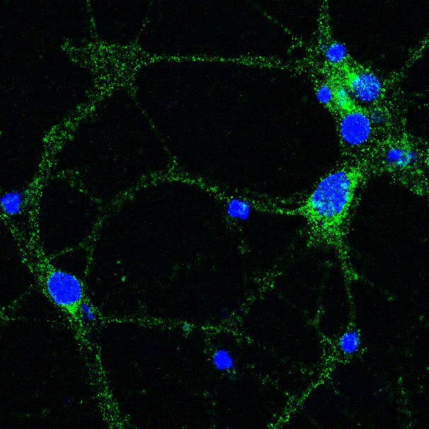 Aducanumab: Approval of new Alzheimer’s disease drug explained